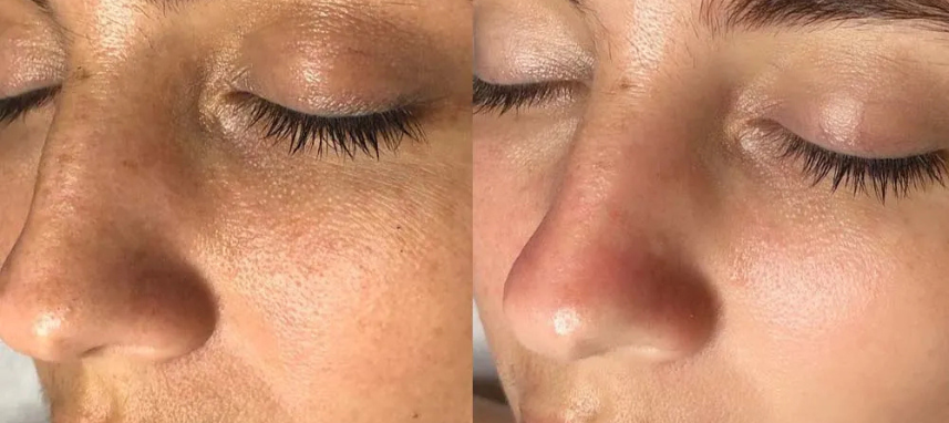 Dark Spots, Melasma, Uneven Skin Tone: TheComplete Guide to Pigmentation Treatment inHyderabad